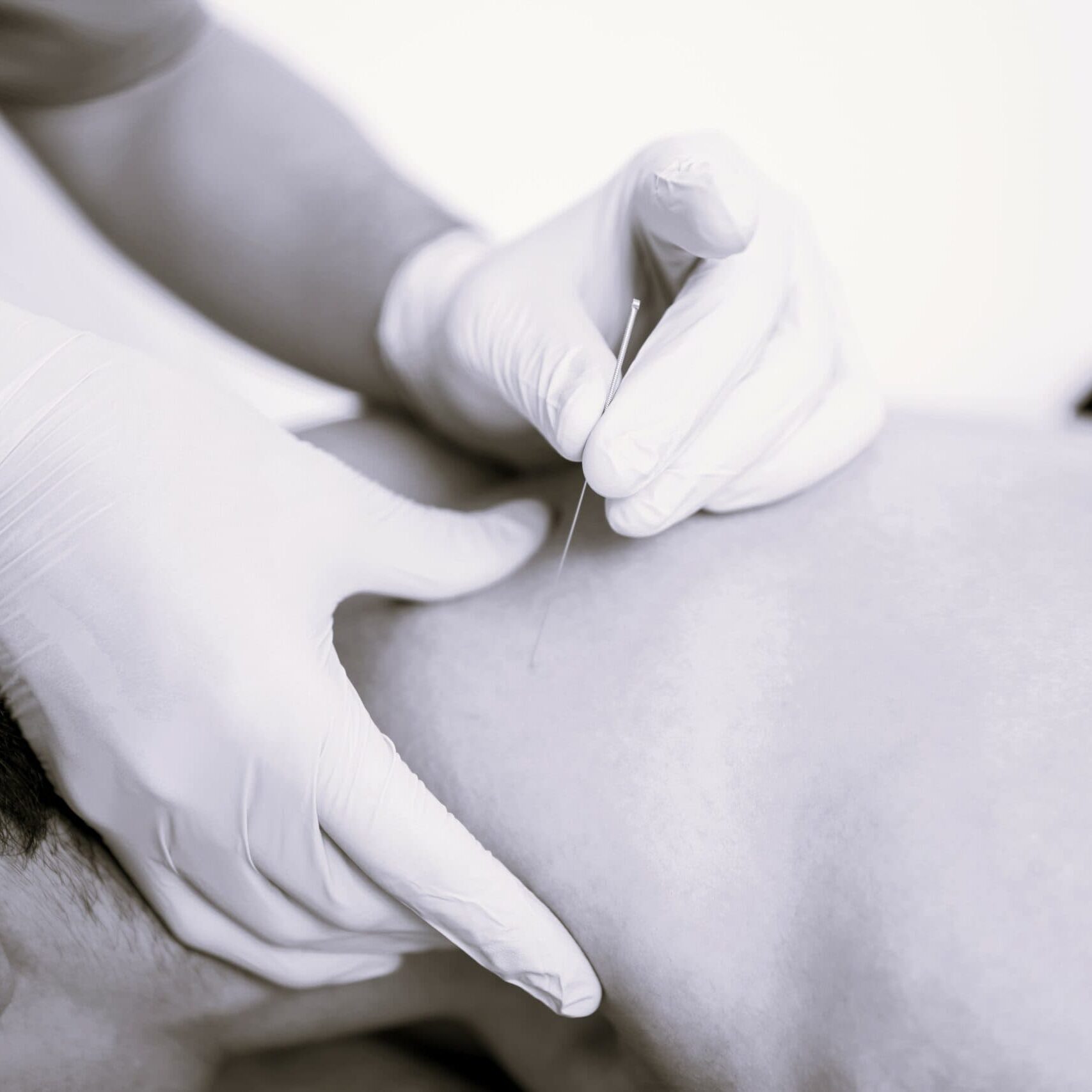 Shirtless Man Receiving Dry Needling Therapy From Doctor Patient receiving trigger point dry needling from a practiced doctor