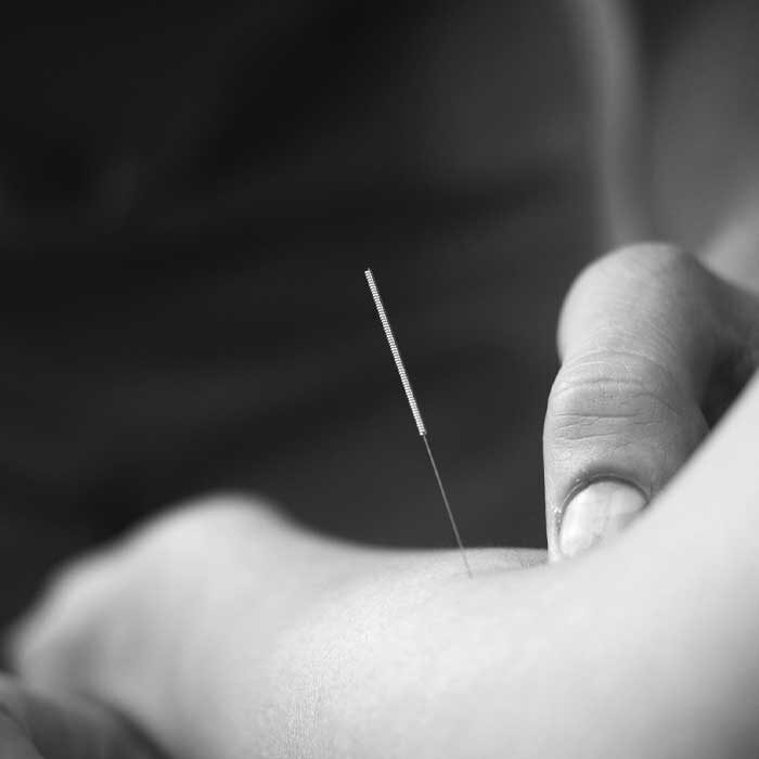 dry needling